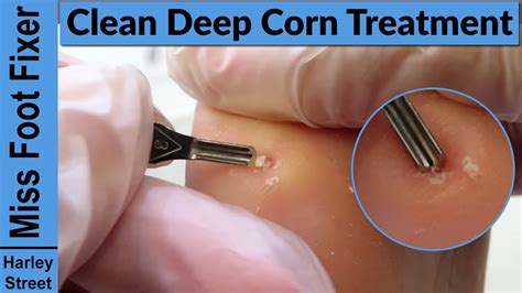 Deep Corn Removal By Podiatrist Treatment By Miss Foot Fixer Marion