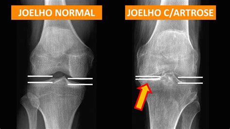 Redução do espaço articular do Joelho Clínica do Joelho