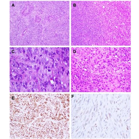 Histological Features Of The Sarcoma The Tumor Is Composed Of A