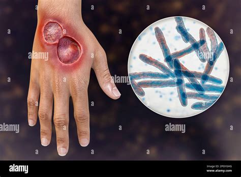 Buruli Ulcer And Mycobacterium Ulcerans Illustration Stock Photo Alamy