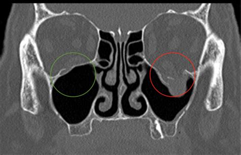 Fracture De Lorbite Fracture Du Plancher Orbital Sos Il