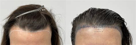 Female Hairline Lowering Transplant Hair Transplant Specialists