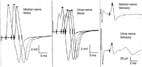 Nerve Conduction Velocity Examination Results Compound Motor Action