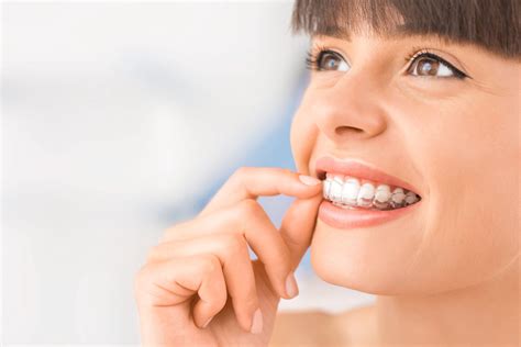 How To Make Invisalign Attachments Less Noticeable Odontologia