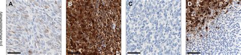 High Grade Endometrial Stromal Sarcomas With Ywhaenutm2 Gene Fusion