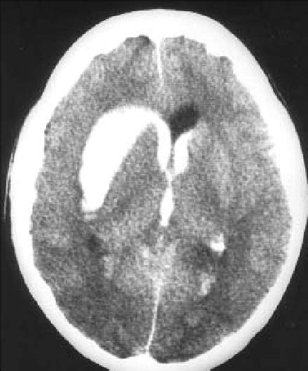 A Noncontrast Computed Tomography Ct Scan On The Day Of Admission