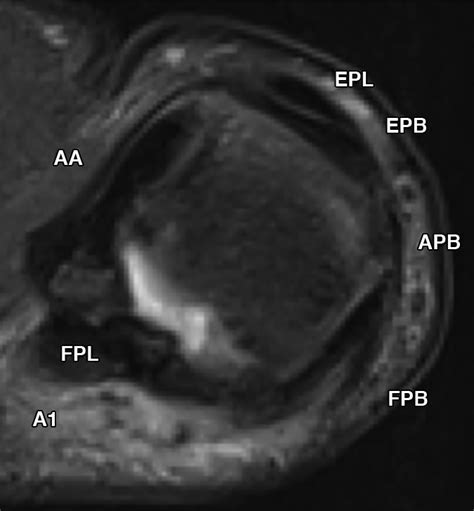 Mri Of The Fingers An Update Ajr