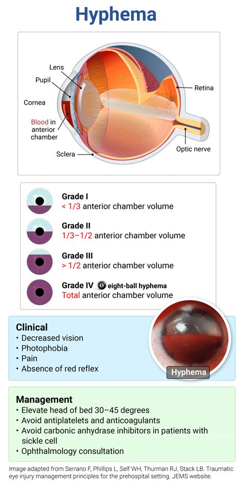 Rapid Review: Hyphema - RoshReview.com