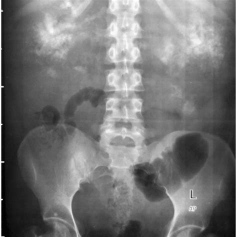 Abdominal Radiograph Showing Large Soft Tissue Mass In Bilateral Renal Download Scientific