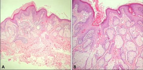 A Marked Acanthotic And Papillomatous Epidermal Hyperplasia With