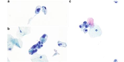 Exemple de cellules urothéliales atypiques avec des rapports N/C ...