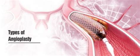 Angioplasty Types Risks Recovery And Procedure Healing Hospital