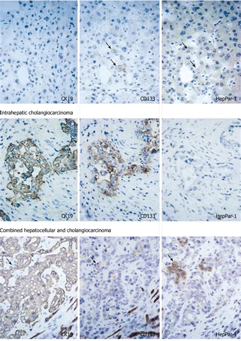 Cd133 Expression In Hcc Intrahepatic Cholangiocarcinoma And Combined