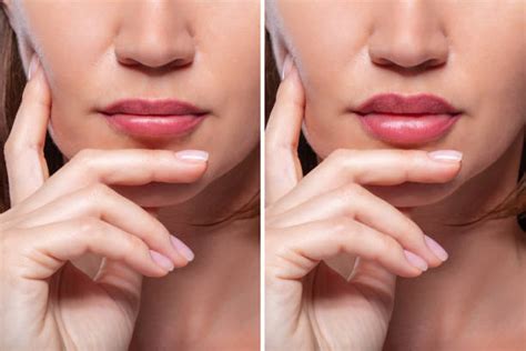 Lip Filler Swelling Stages What To Expect After Your Procedure BeautyPg