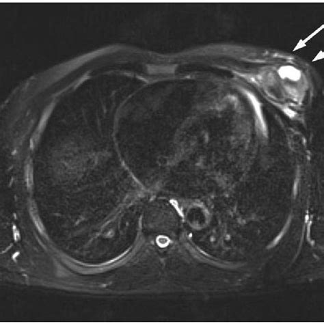 T2 Weighted Axial Chest MRI Reveals No Invasion By Tumor Of The