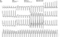 Atrioventricular Nodal Reentry Tachycardia