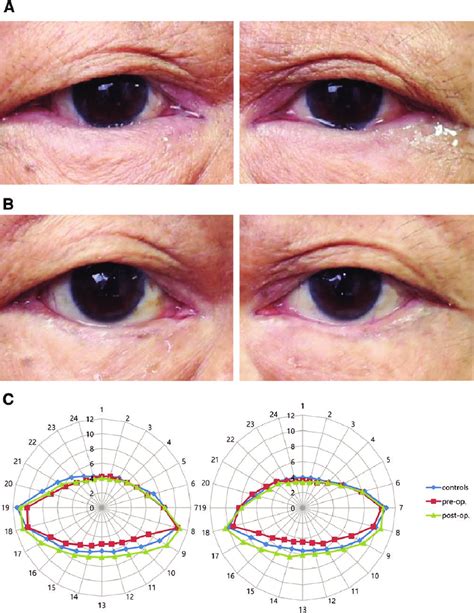 Clinical Photographs Of The Eyelids With The Diagnosis Of Entropion In