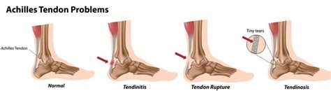 Torn Achilles Tendon Symptoms