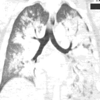 Ct Chest Coronal View Demonstrating Bilateral Diffuse Lung