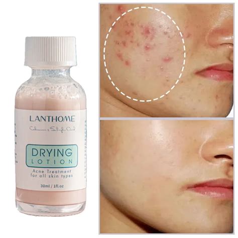 Calamine Lotion Acne