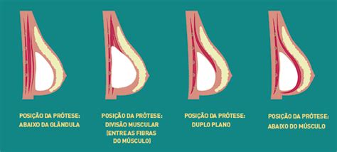 Qual a posição ideal dos implantes de silicone