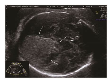 Axial View Of The Fetal Head After Intrauterine Transfusion Procedure