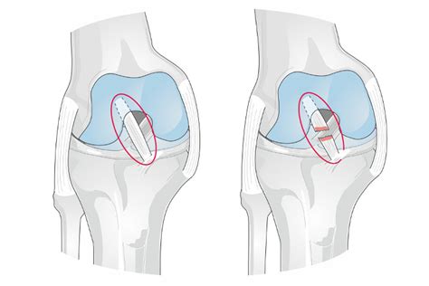 Mengenal Cedera Acl Pada Lutut Gejala Dan Penyebabnya Klinik Patella