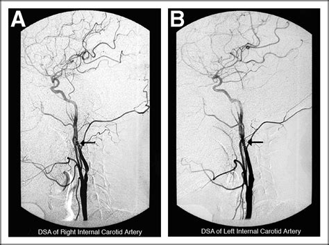 Carotid Artery Fibromuscular Dysplasia The American Journal Of Surgery