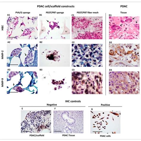 Histological Micrographs Of Ac Pancreatic Ductal Adenocarcinoma Download Scientific Diagram