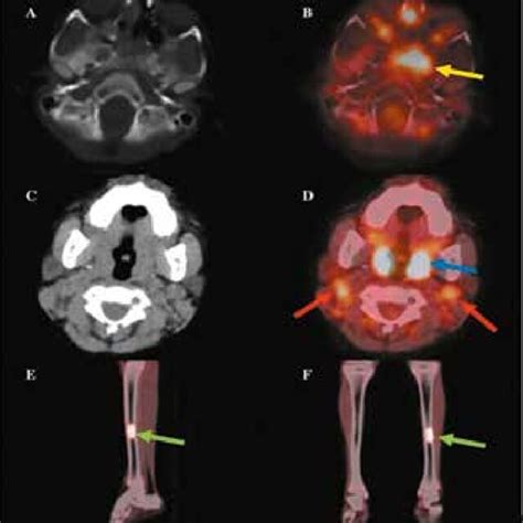 F Fdg Pet Ct Results Axial Ct A And Axial Fused B Images Showing