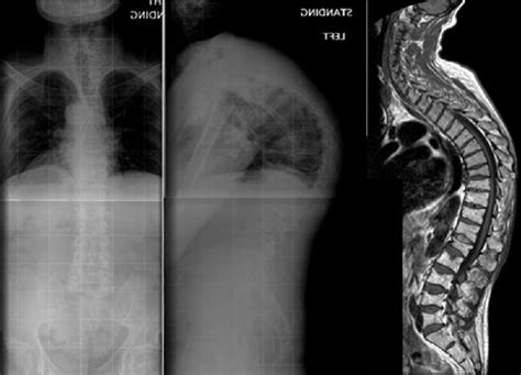 Figure 1 From Staged Correction Of Severe Thoracic Kyphosis In Patients With Multilevel