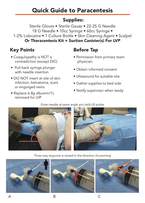 Quick Guide – Paracentesis