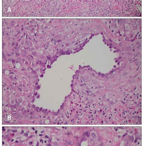 Histopathologic Examination Reveals Dense Multiple Lobular