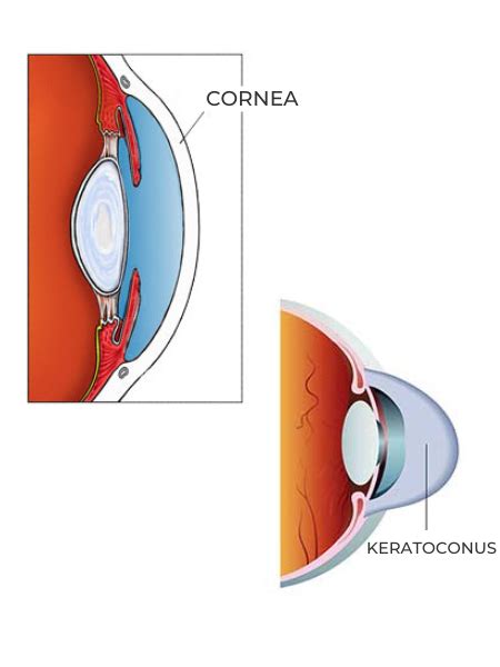 Corneal Conditions Treatments For Keratoconus Rottman