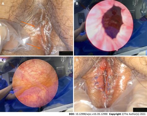 Nearly Complete Labial Adhesions Diagnosed With Repetitive Cystitis In