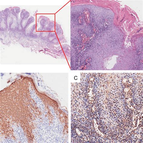 A During Labial Mass Excision Histopathologic Examination Showed