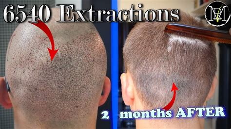 Haircut 2 Months After Hair Transplant Donor Area Nw5a 6500 Grafts