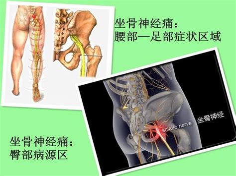 坐骨神經痛可導致臀部以下癱瘓，如何破？ 每日頭條