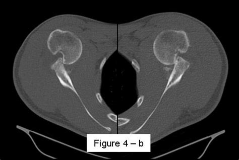 A A Case Of Bilateral Engaging Hill Sachs Lesion On Ap X Ray 108x58mm Download Scientific