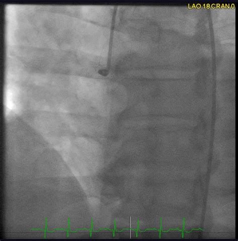 Figure Coronary Angiogram In A Patient Statpearls Ncbi Bookshelf