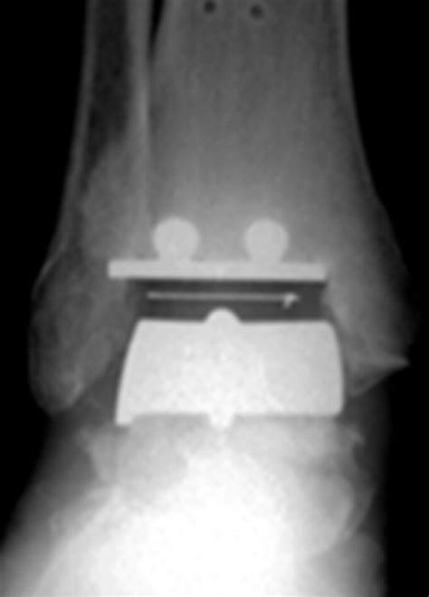 Total Ankle Arthroplasty A Radiographic Outcome Study AJR