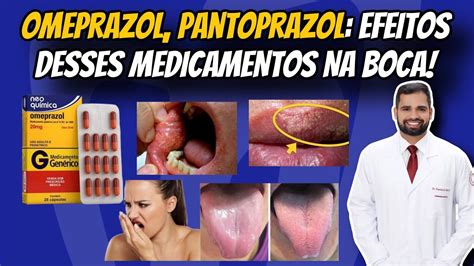 Omeprazol Pantoprazol E Similares Efeitos Na Boca E Como Tratar