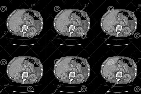 Computed Tomography Ct Whole Abdomen In Axial Part Sixteen Stock Image