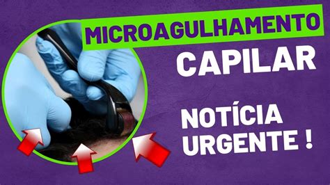 Microagulhamento Capilar Em S O Paulo Morumbi Cl Nica Especialista