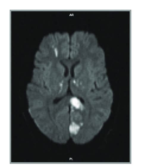 Fabry Disease Axial Diffusion Weighted MRI Sequence Obtained At The