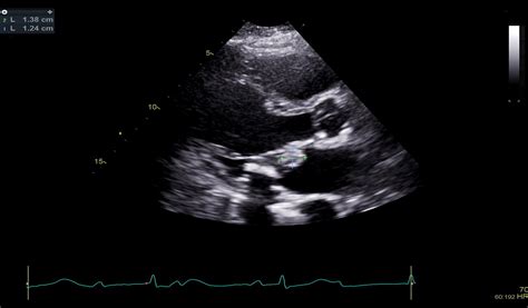 Cardiac Imaging For Diagnosis And Management Of Endocarditis