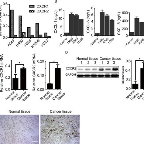 Expression Of Cxcr And Cxcr Receptors In Human Lung Cancer Tissue And