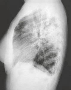 Neumon A Eosin Fila Cr Nica Medicina General Y De Familia