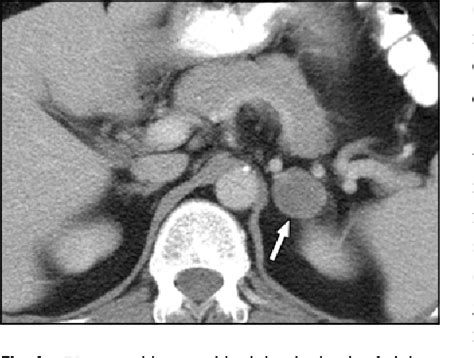 Pdf The Incidental Indeterminate Adrenal Mass On Ct H In