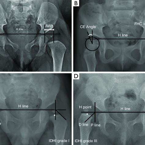 Radiographic Measurement On Pelvic Anteroposterior View The